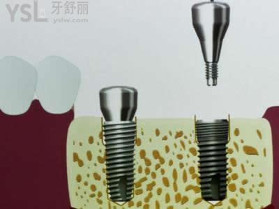 士卓曼種植體分為兩大類