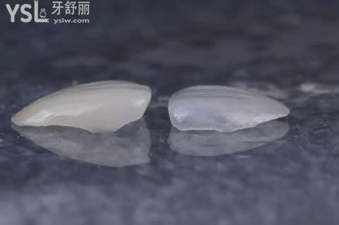 牙齒貼面的分類？