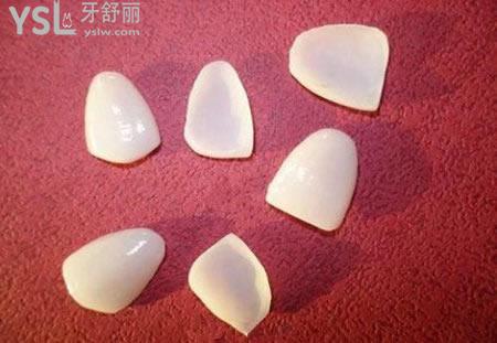 醫(yī)生建議做烤瓷牙貼面要謹慎？