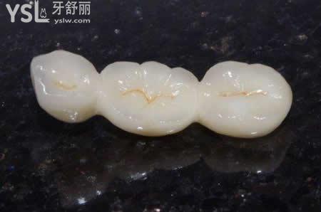 氧化鋯烤瓷牙的特點(diǎn)？