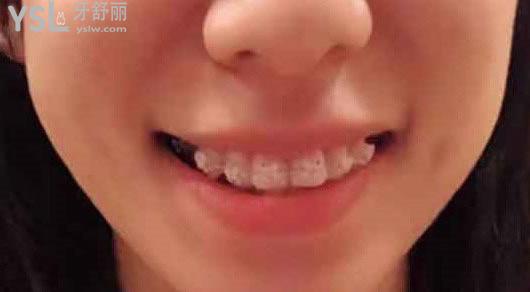 戴牙套的小姐姐