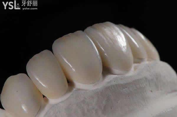 烤瓷牙有什么優(yōu)點(diǎn)？