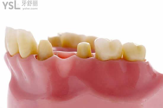 哪七個步驟可以搞定種植牙？