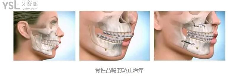 骨性凸嘴的矯正治療過程