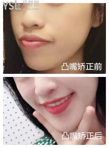小欣矯正前后對比圖
