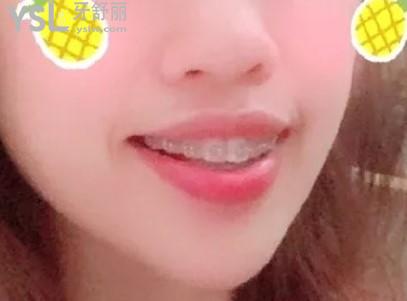 小欣戴牙套的樣子