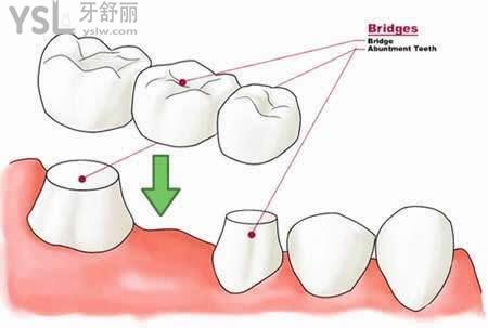 種牙術(shù)后維護(hù)和保養(yǎng)？