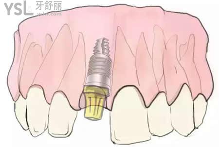 全口牙種植后注意事項(xiàng)？