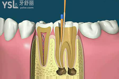 根管治療的具體過(guò)程？