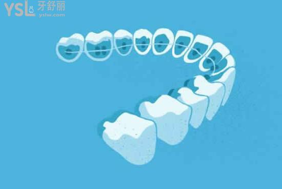 牙齒矯正圖示