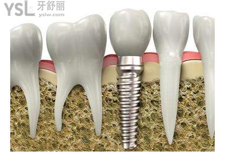 種植牙成功的判斷標(biāo)準(zhǔn)是什么？