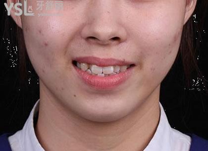 25歲整牙前后照片