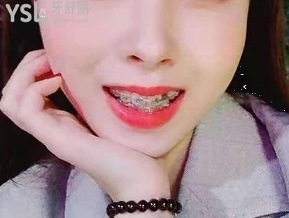 25歲整牙前后照片