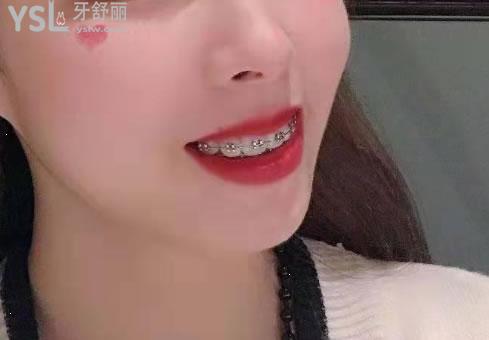 25歲整牙前后照片