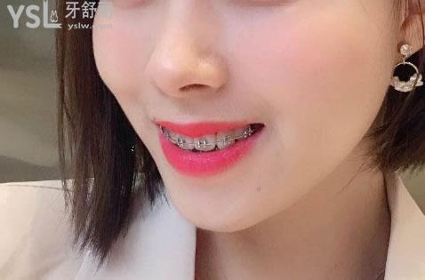 25歲整牙前后照片