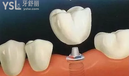 德國Bedo種植體