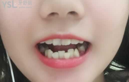 二十歲矯正牙齒后悔，只要去正規(guī)的口腔醫(yī)院就不會(huì)給你后悔的機(jī)會(huì)