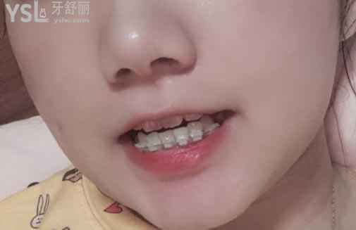 二十歲矯正牙齒后悔，只要去正規(guī)的口腔醫(yī)院就不會(huì)給你后悔的機(jī)會(huì)