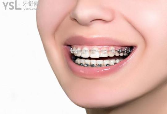 牙齒矯正
