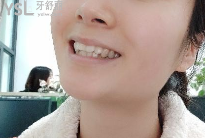 帶牙套后悔一輩子，我覺得不帶牙套才會后悔