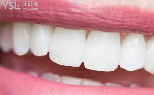 自鎖牙套