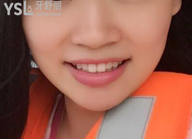 戴牙套一個月不想戴了，矯正的結(jié)果是值得你堅持下去的，加油。