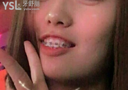 牙齒矯正被坑了一輩子