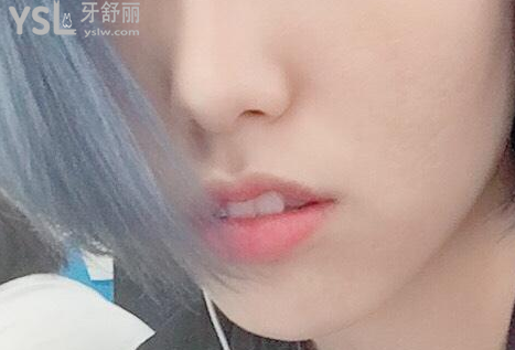 牙齒矯正被坑了一輩子