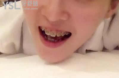 20歲整牙還來得及嗎，有想法的時候立馬行動到時候你會感謝我的