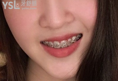 20歲整牙還來得及嗎，有想法的時候立馬行動到時候你會感謝我的