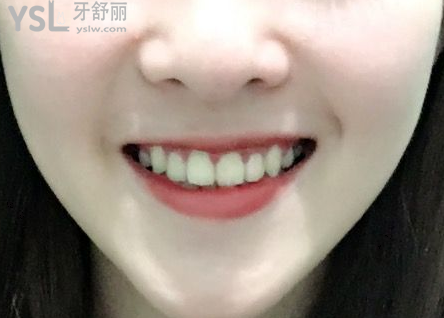 20歲整牙還來得及嗎，有想法的時候立馬行動到時候你會感謝我的