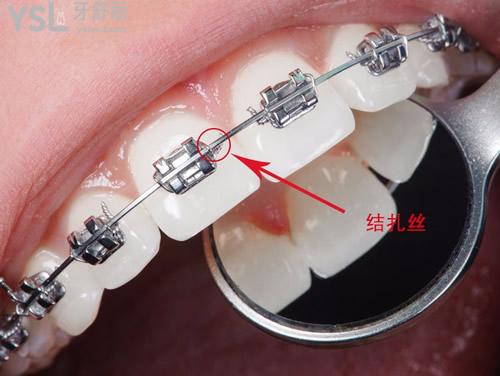 陶瓷矯正器和金屬矯正器哪個(gè)更好?