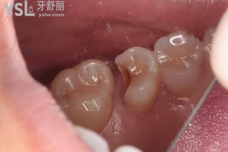 樹(shù)脂補(bǔ)牙材料好嗎？