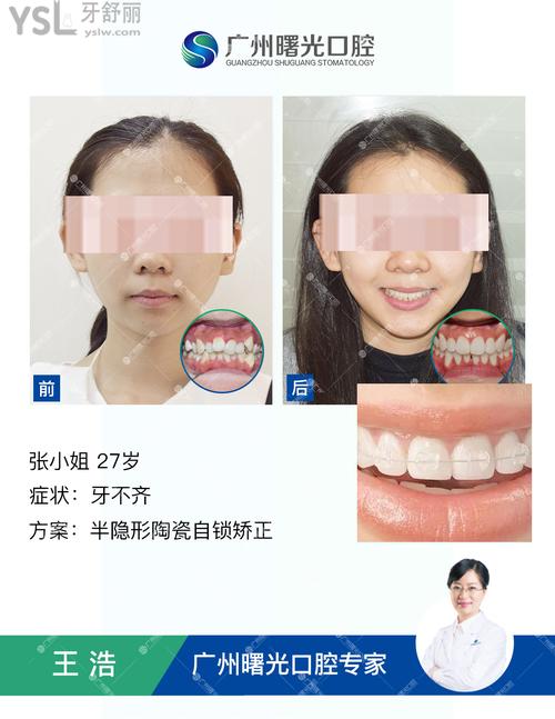 30歲可以矯正牙齒嗎，我馬上三十你看我的對比圖就知道了。