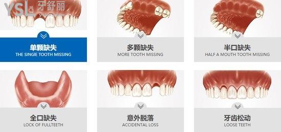 武漢清華陽光口腔種植牙
