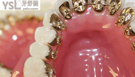 陶瓷矯正器和金屬矯正器那個更好？