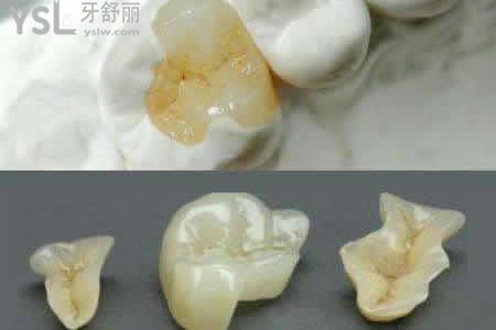 樹脂補牙使用的壽命與那些因素有關？