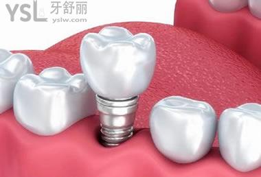 種植牙一般都有哪些優(yōu)點(diǎn)？