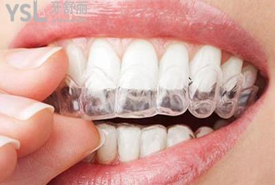 隱適美隱形矯正的優(yōu)勢(shì)：