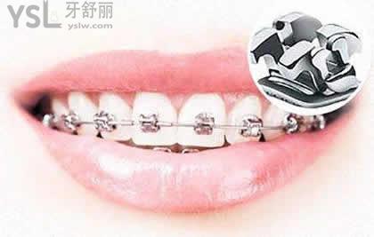 金屬自鎖托槽矯正有以下優(yōu)點：