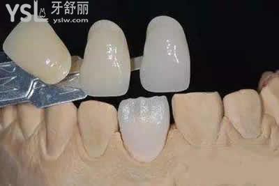 為什么有的人做了牙貼面會后悔？