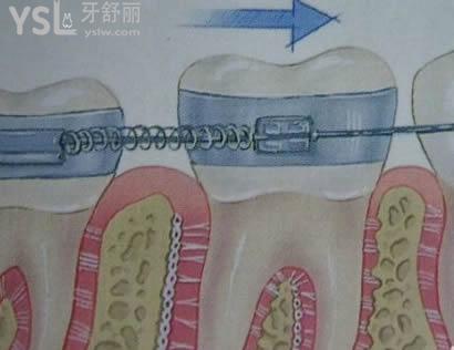金屬托槽會傷害牙齒嗎？