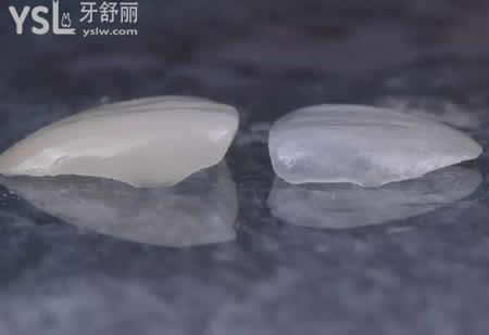 做全瓷貼面有哪些要注意的？