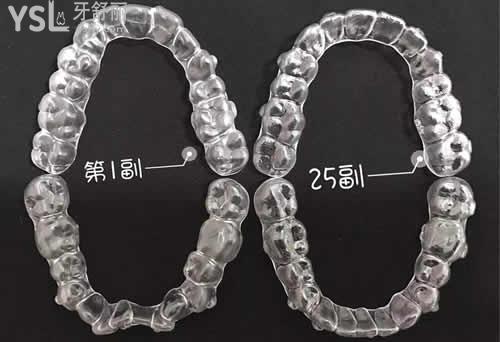 為什越來越多人選擇隱形矯正？
