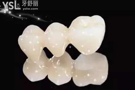 全瓷牙主要分為哪幾種？