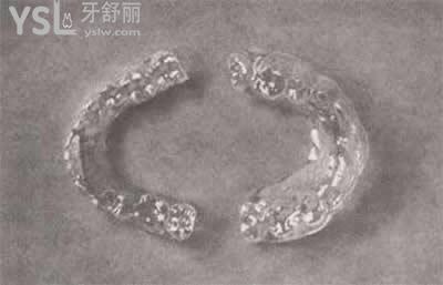 時代天使隱形矯正適應人群和優(yōu)點：
