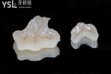 嵌體是什么：
