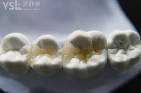 鑄瓷嵌體的優(yōu)勢(shì)：