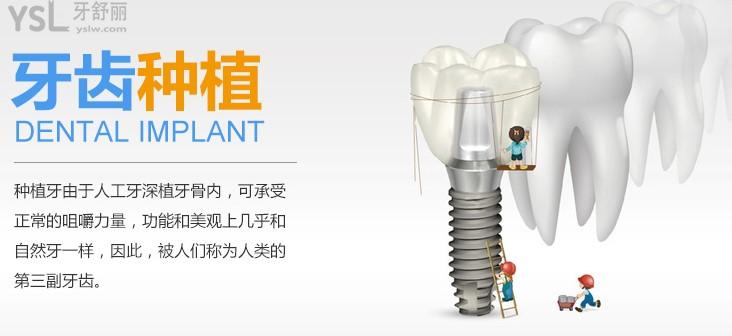 福州三顆牙口腔種植牙