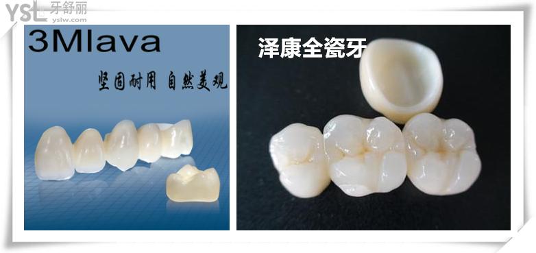 美國3M拉瓦全瓷牙和澤康全瓷牙